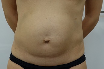 Stav před laserovou liposukcí břicha