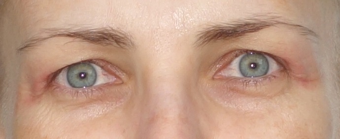 Oči 5,5 týdne po zákroku