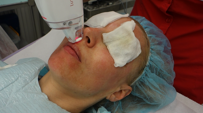 Aplikace laseru přímo v kontaktu s kůži na celém obličeji