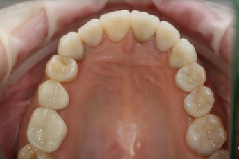 Stav po rekonstrukci zubů