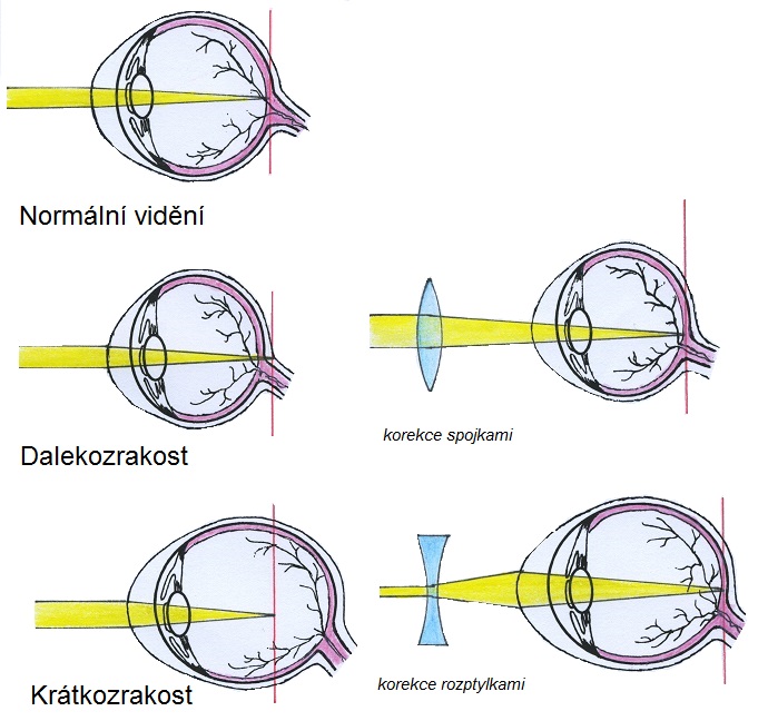 Normální vidění, dalekozrakost (presbyopie), krátkozrakost (myopie) - korekce