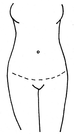 Abdominoplastika - miniabdominoplatika