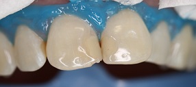 Pro dokonalý výsledek nesmí izolace přesahovat vetší část zubu, ale musí dostatečně těsnit.