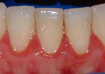 Dentální hygiena - zánět dásně