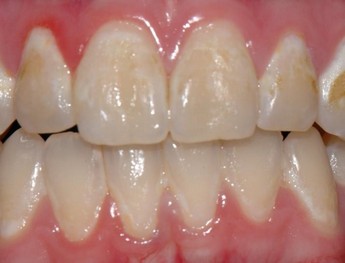 Dentální hygiena - zubní kaz
