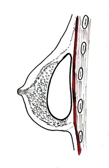 Prsní implantát vložený pod prsní žlázu