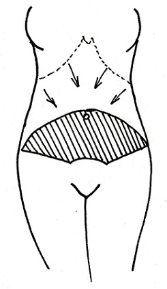 Abdominoplastika