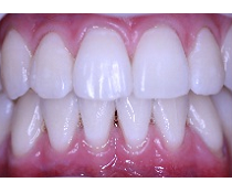 Bělení zubů – jak vybělit zuby 